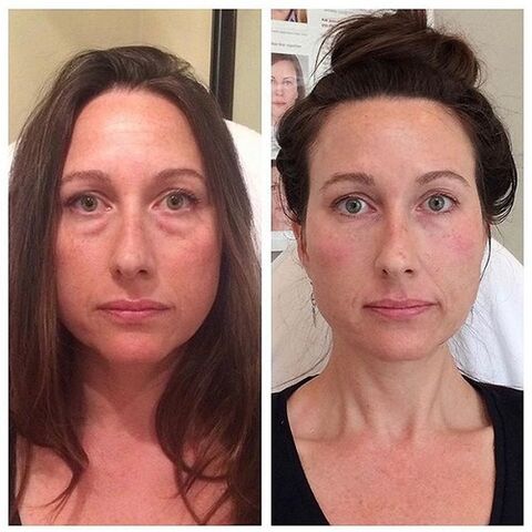 Cô gái trước và sau khi trẻ hóa da mặt bằng laser