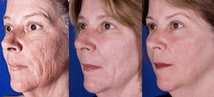 Kết quả sau liệu trình trẻ hóa da mặt bằng laser