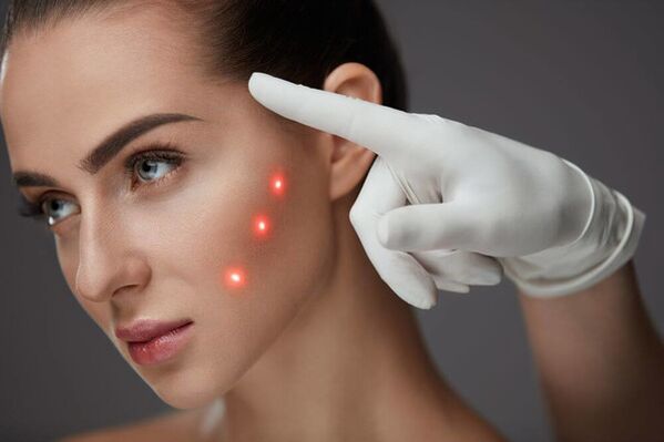 Trẻ hóa da mặt bằng laser