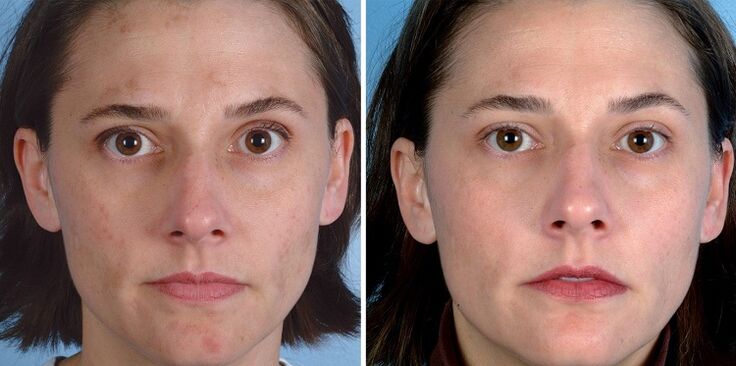 trước và sau khi trẻ hóa da bằng thiết bị