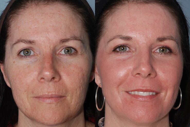 trước và sau khi trẻ hóa da phần cứng