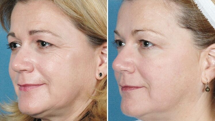 ảnh trước và sau khi trẻ hóa da phần cứng