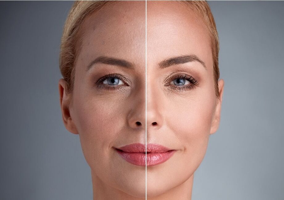 trước và sau khi trẻ hóa da mặt bằng laser