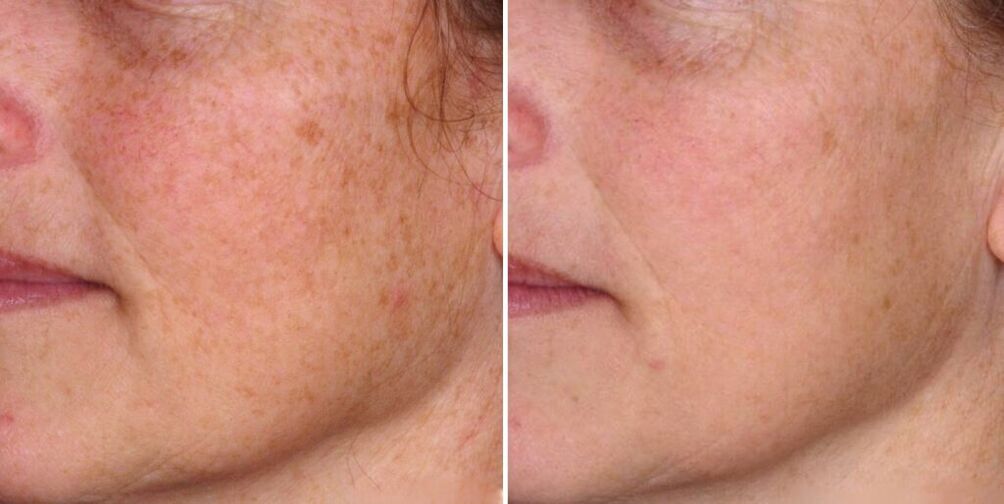 da mặt trước và sau khi trẻ hóa